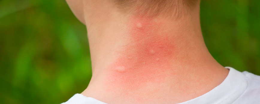 Alergia a los insectos