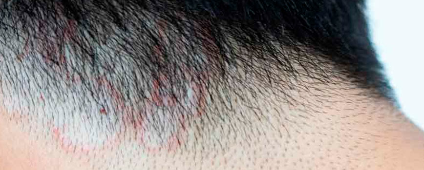 5. Tinea capitis