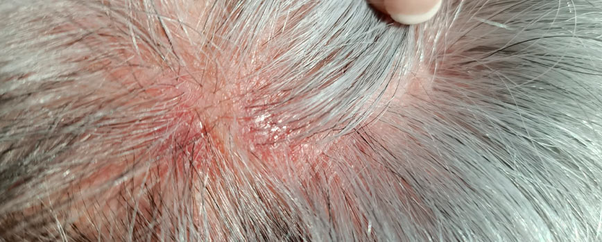 6. Herpes Zóster