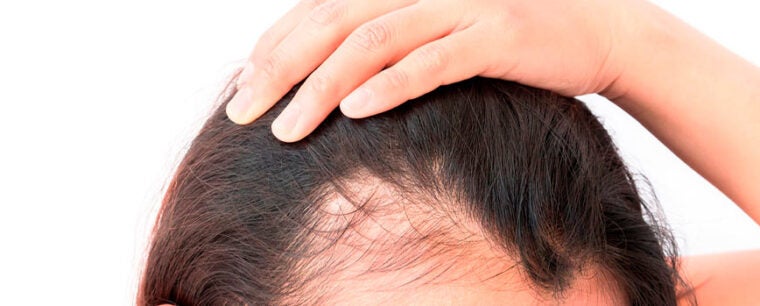 Me Duele El Cuero Cabelludo Al Mover El Pelo www.druni.es