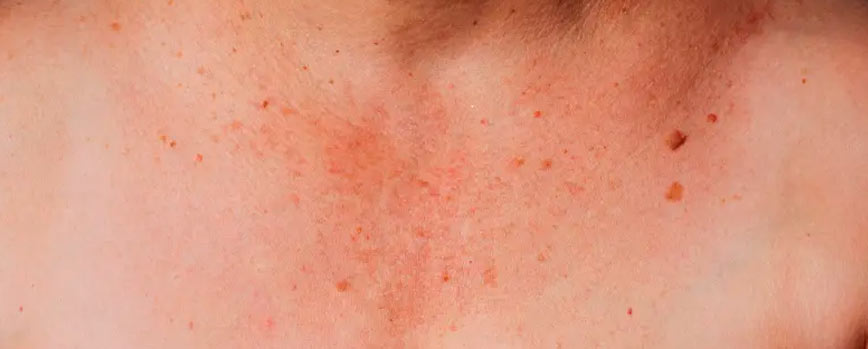 Antes de nada, ¿por qué aparecen las manchas en la piel del escote?