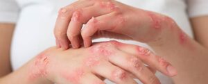 Hongos en la piel: ¿Cómo identificarlos y cómo tratarlos? | Blog Druni