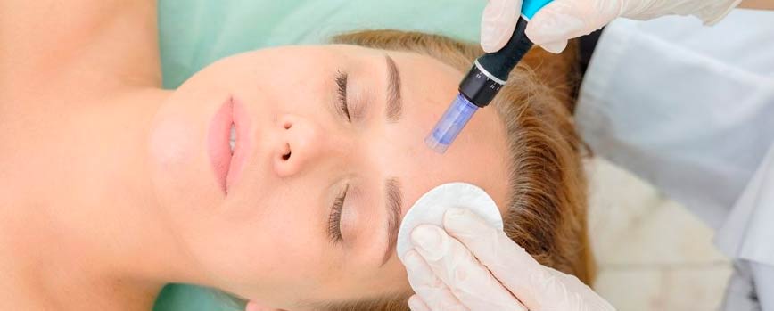 ¿Qué es el microneedling y a quién va orientado?