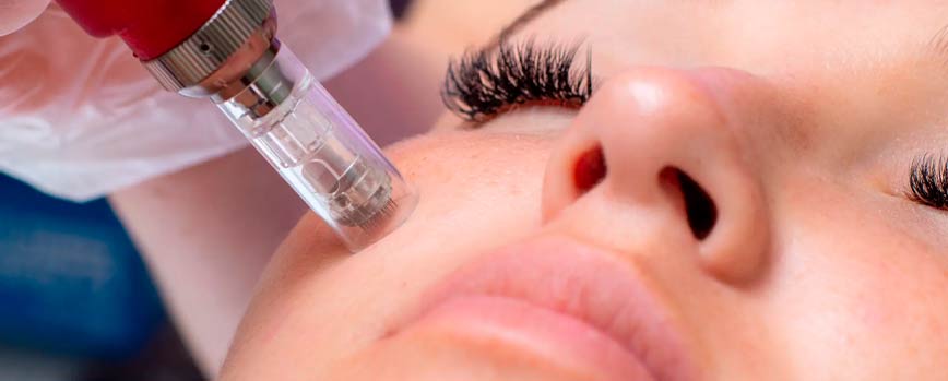 ¿Para qué sirve el microneedling? 5 beneficios espectaculares