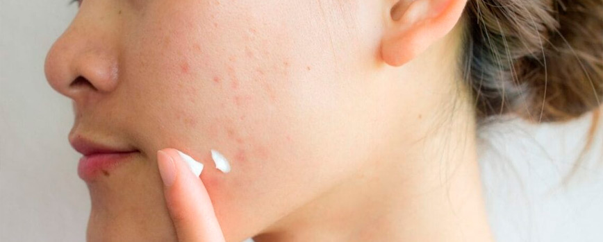 ¿Por qué apostar por una crema hidratante para piel con acné?