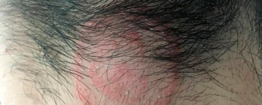 #4. Podrías contraer infecciones cutáneas