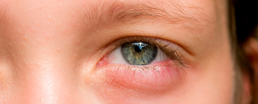 ¿Qué es una infección ocular?
