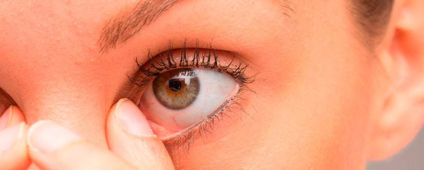 ¿Cómo saber si tengo una infección ocular? Síntomas: