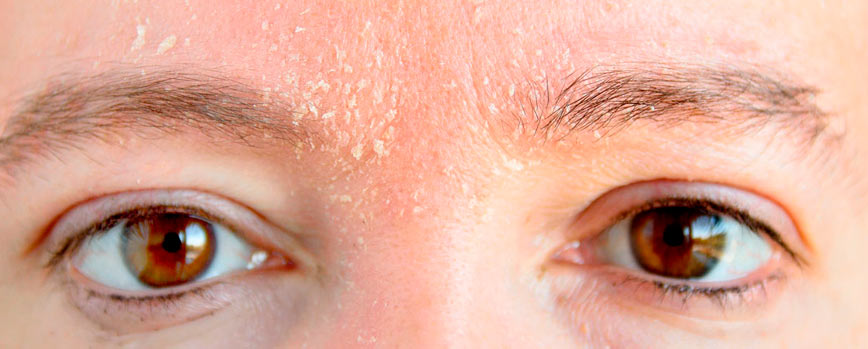 #6. Dermatitis