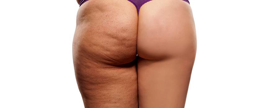 Tratamiento de la celulitis, cicatrices y estrías