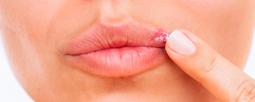 ¿Qué es el herpes labial?