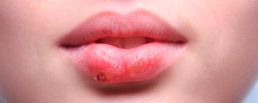 Causas del herpes labial