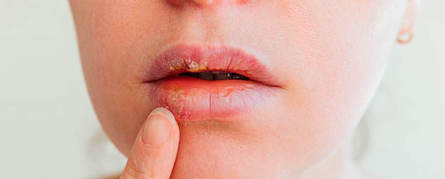 Principales síntomas del herpes labial