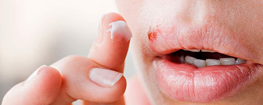 ¿Cómo tratar el herpes labial?