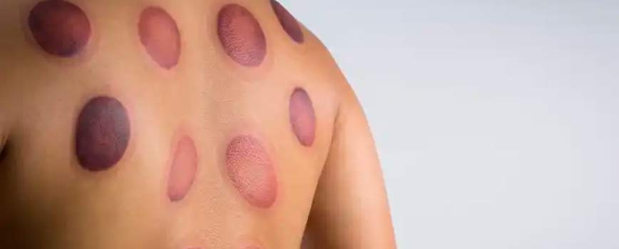 ¿La terapia con ventosas tiene efectos secundarios?