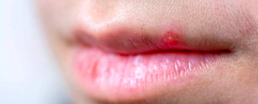 ¿Por qué salen los granos en los labios?