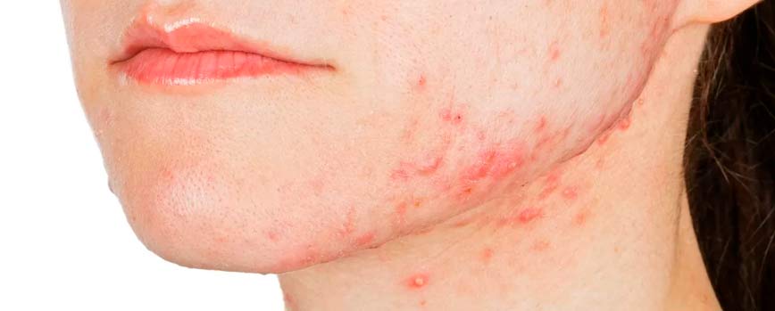 ¿Por qué salen granos en el cuello?