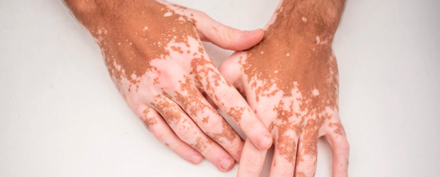 ¿Qué son las manchas blancas de la piel?