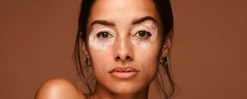 ¿Por qué salen manchas blancas en la piel?
