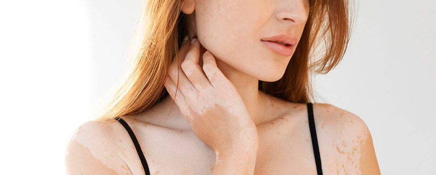 ¿Cómo quitar las manchas blancas de la piel?