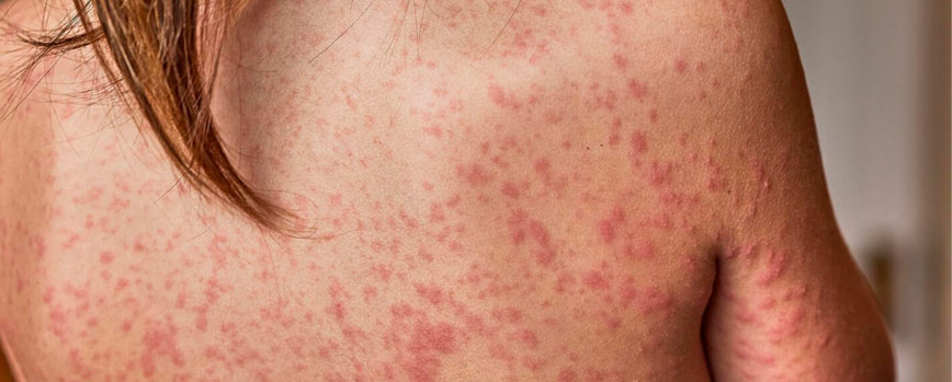 ¿Por qué salen manchas rojas en la piel?
