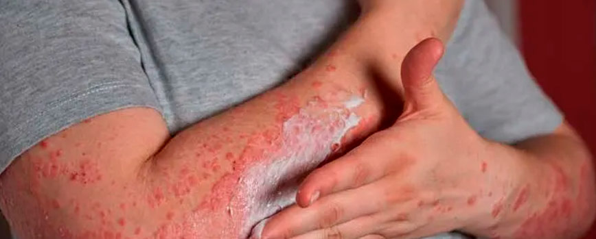 ¿Cómo quitar las manchas rojas de la piel?