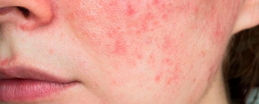 ¿Por qué salen manchas rosadas en la piel?