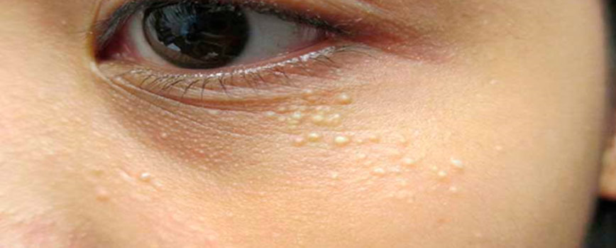 ¿Por qué salen milium en la cara?