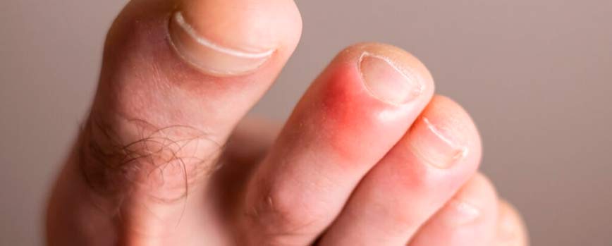¿Qué son los sabañones en los pies y por qué se producen?