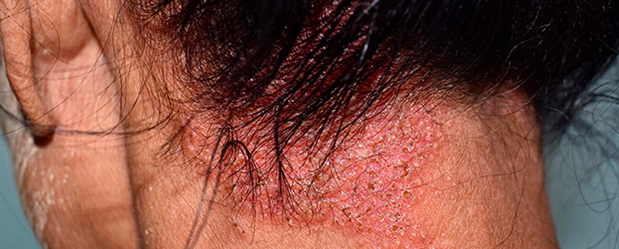 #2. Pitiriasis Esteatoide