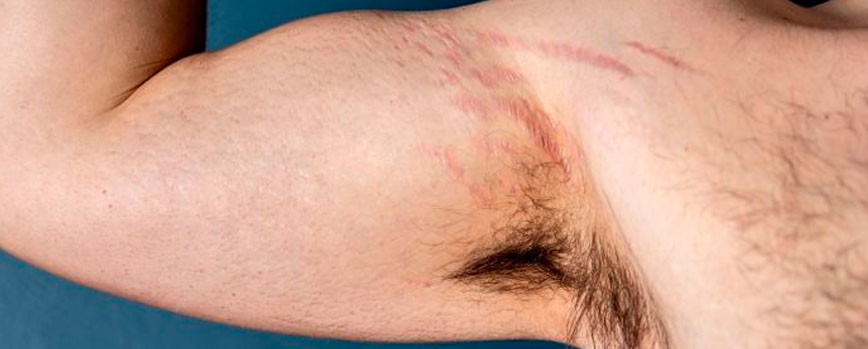 ¿Se pueden eliminar las estrías rojas en hombres?