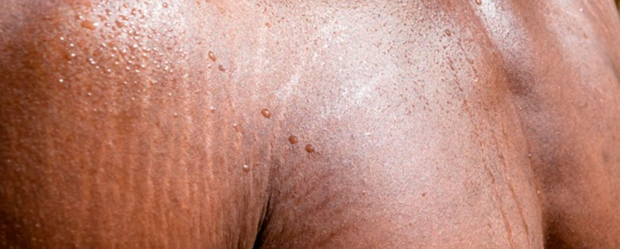 ¿Se pueden eliminar las estrías blancas en hombres?