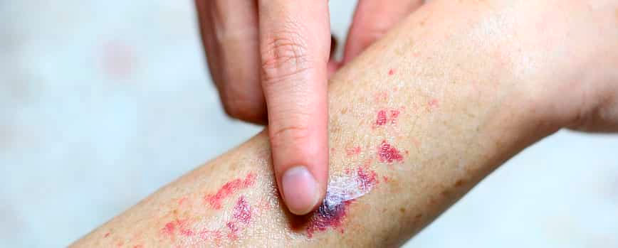 ¿Cómo quitar las manchas moradas de la piel?