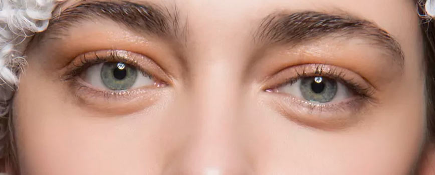 ¿Qué son y qué tipos de ojeras hundidas hay?