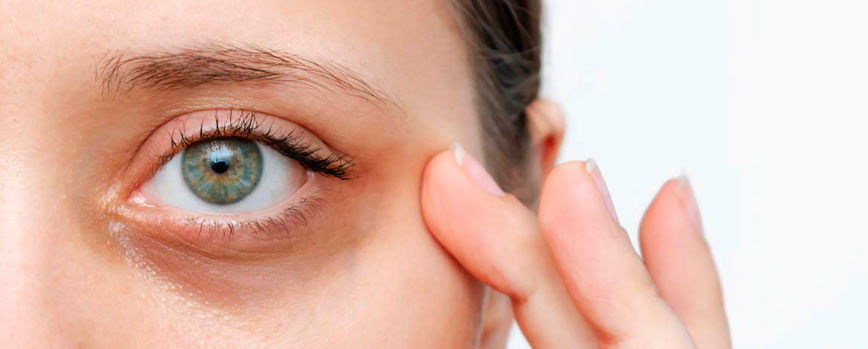 ¿Cuáles son las características de las ojeras pigmentadas?