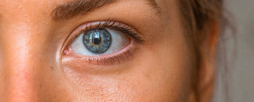 Causas de las ojeras pigmentadas