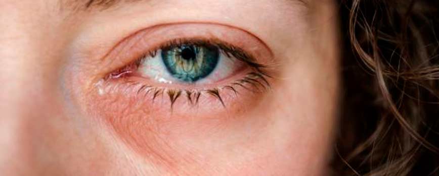 ¿Por qué salen ojeras rojas?