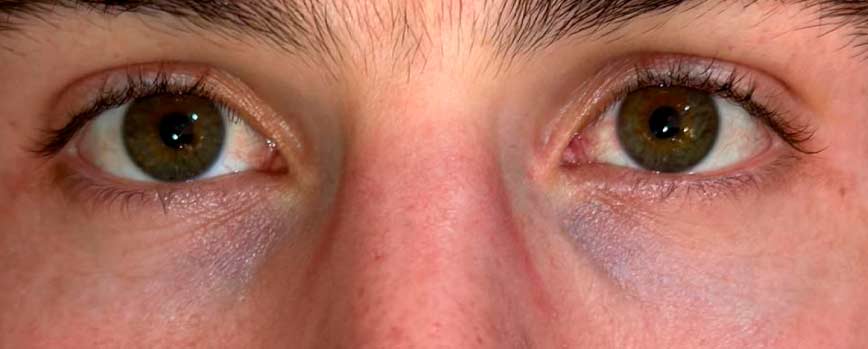 ¿Qué son las ojeras vasculares?