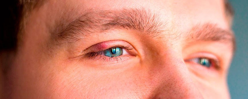 ¿Cuáles son las causas de los ojos hinchados?
