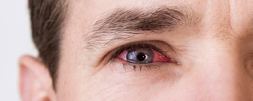¿Cómo quitar los ojos hinchados? Tratamiento