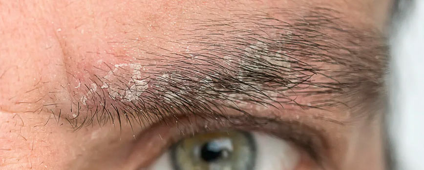 ¿Por qué tengo caspa en las cejas? Causas