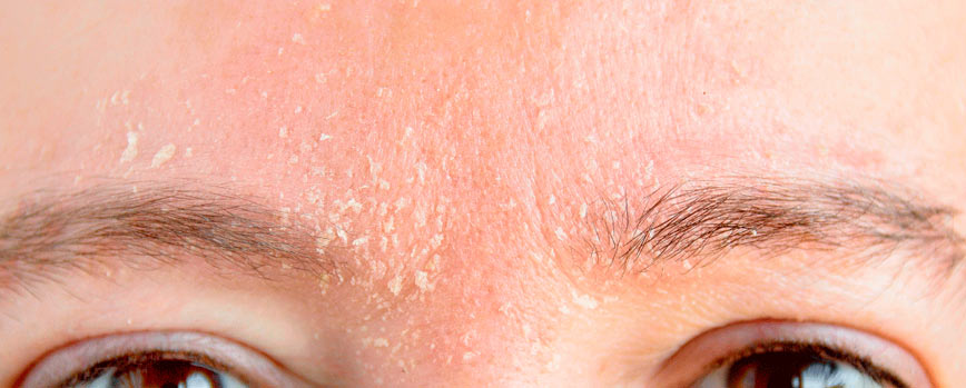 ¿Cómo eliminar la caspa en las cejas?
