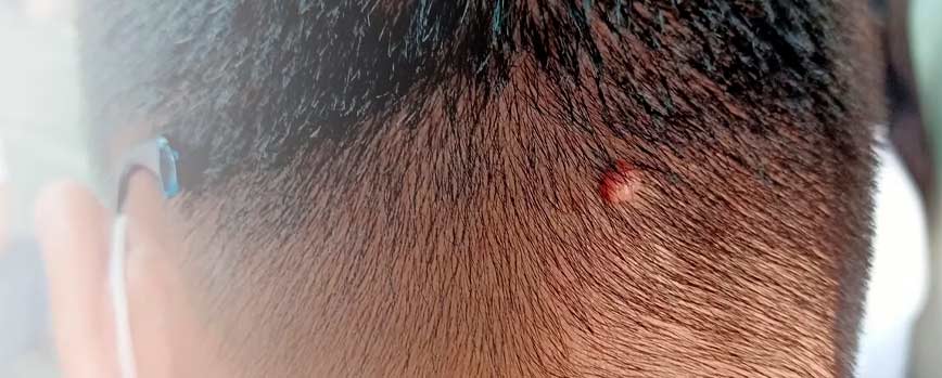 ¿Cuáles son las causas de las verrugas en la cabeza?
