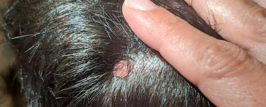 Tipos de verrugas en la cabeza