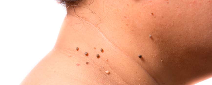¿Qué son y qué tipos de verrugas en el cuello hay?