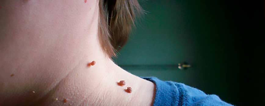 Causas de las verrugas en el cuello