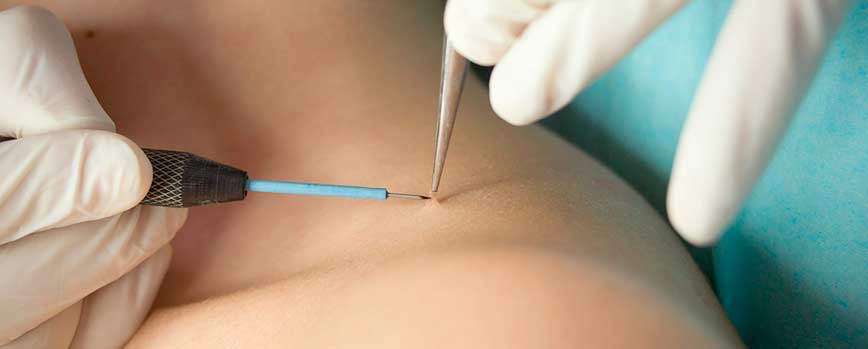 ¿Cómo quitar las verrugas en el cuello?