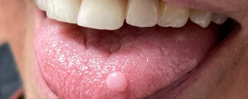¿Qué tipos de verrugas en la lengua existen y cuáles son sus causas?