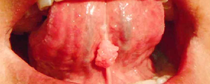 Verrugas en la lengua: ¿Cómo eliminarlas?