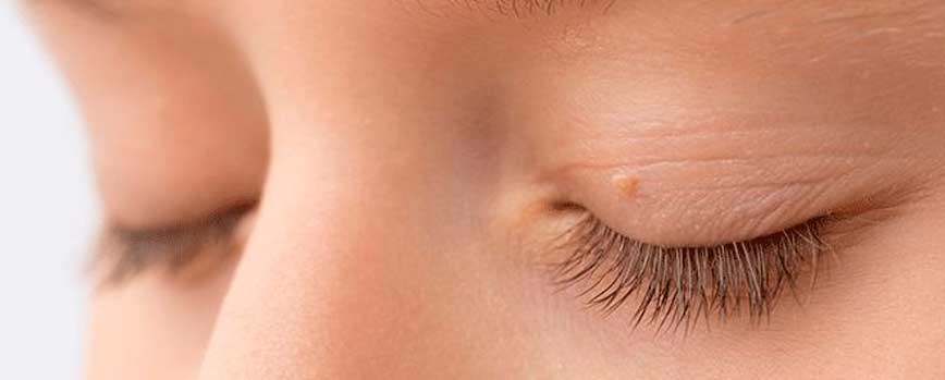 ¿Qué tipo de verrugas en el ojo existen?
